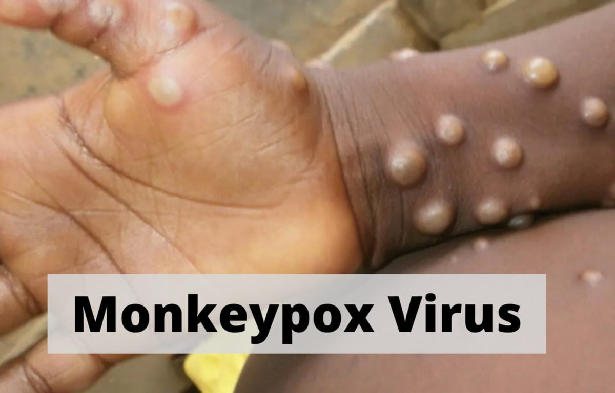 Monkeypox Virus