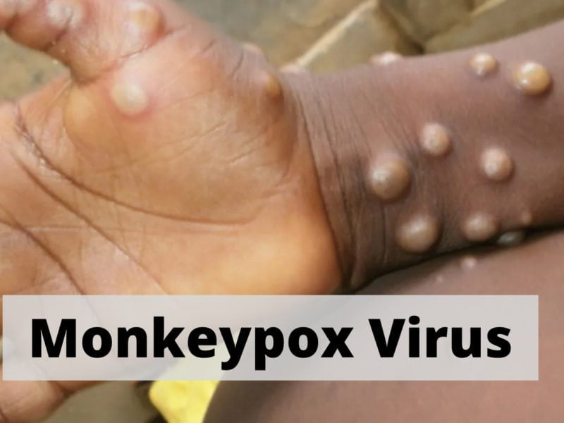 Monkeypox Virus